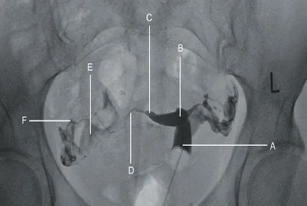 HSG Hysterosalpingogram