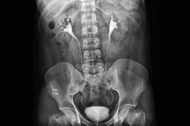 IVP Intravenous Pyelogram