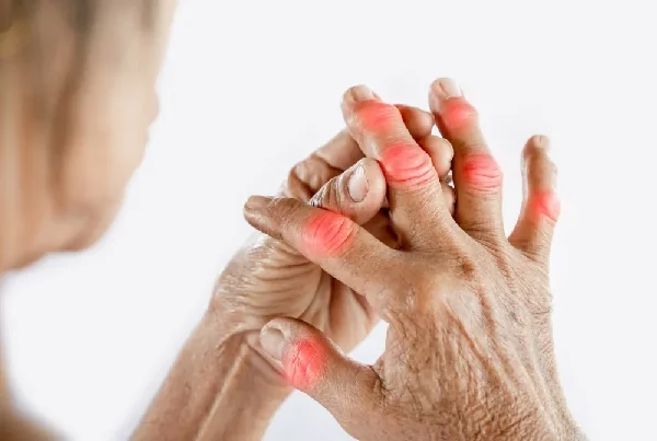 Treatment of Arthritis