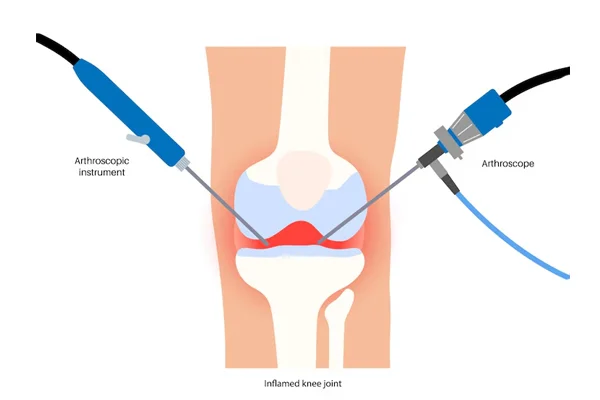 Arthroscopic Surgeries for Ligament and Sports Injuries